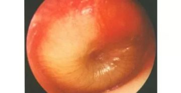 Булла в ухе у ребёнка 5 лет (буллезный отит)