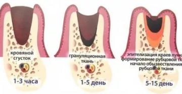 Выпал сгусток на 5 день после удаления сложного зуба (6)