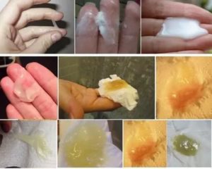 После поименения утрожестана утром вытекла липкая водичка