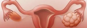 Эндометриоз и низкий прогестерон