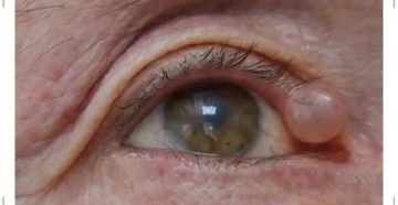 Киста Молля