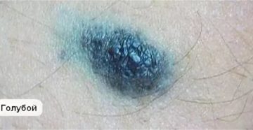 Пятно синего цвета на члене Пятно синего цвета на члене