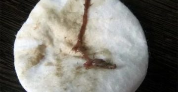 Коричневые выделения после лечения флюкостатом