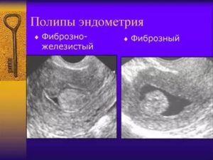 Лечение после выскабливания: железисто-фиброзный полип эндометрия