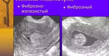 Лечение после выскабливания: железисто-фиброзный полип эндометрия