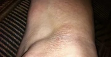 Сухое темное пятно на щиколотке ног