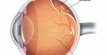 Лечебная гимнастика после операции по отслойки сетчатки