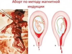 Медикаментозный аборт после кесарева