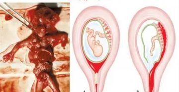Медикаментозный аборт после кесарева