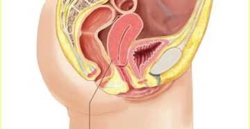 Боль стенки влагалища