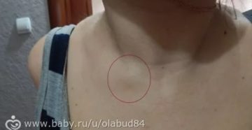 После падения у ребенка шишечка на ключице