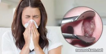 Сожгла слизистую носа Сожгла слизистую носа