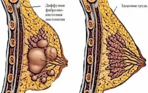 Фиброзно-кистозная мастопатия, отдающие боли в подмышку