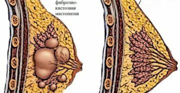 Фиброзно-кистозная мастопатия, отдающие боли в подмышку