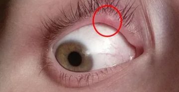 Прыщик под верхним веком