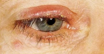 Чешется и гноится глаз