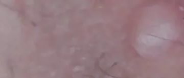 Мягкое вздутие на половом органе Мягкое вздутие на половом органе