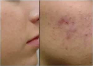 Прыщи переходящие в язвочки и проходящие оставляя шрам