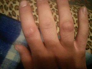 Кожистые наросты на суставах пальцев руки у ребёнка