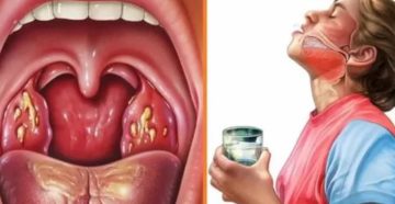 Рак или тонзиллит? Рак или тонзиллит?