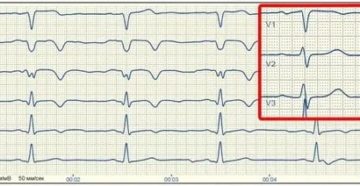 Изменения зубца Т. ишемия передней стенки у ребёнка