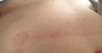 Пятна на животе и под грудью, бледнеют, потом снова появляются