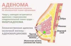 Болит грудь и сосок