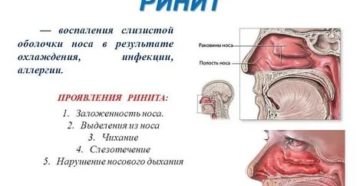 Болит горло без насморка