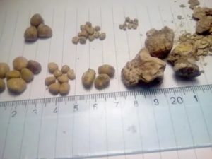 В правой почке камень 15 мм. Что делать?
