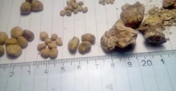 В правой почке камень 15 мм. Что делать? В правой почке камень 15 мм. Что делать?