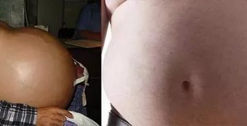 Помогите! Опухла грудь и надулся живот