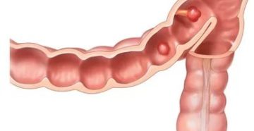 Полип толстой кишки