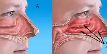 Внутренний насморк в одной ноздре