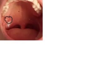 Чёрная точка на миндалине Чёрная точка на миндалине