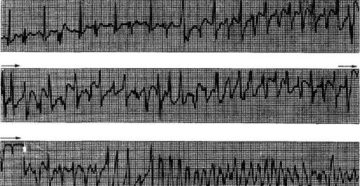 Мучает аритмия (экстрасистолия)