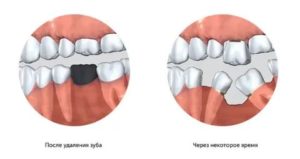 Смещение кости после удаления зуба