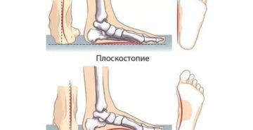 Плоскостопие