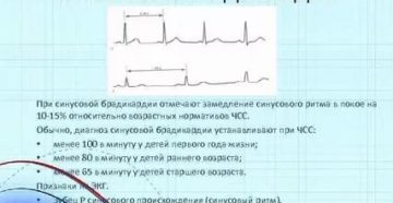 Заключение синусовая брадикардия