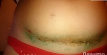 Киста на рубце после кесарева сечения