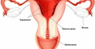Усилен сосудистый рисунок миометрия, большая матка в середине цикла