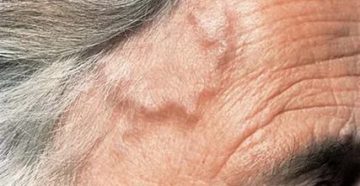 Болит голова, вздулась вена на голове, головокружение