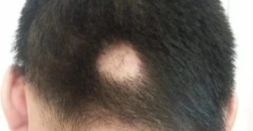 Пятно на голове без волос