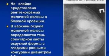 Киста правой молочной железы с нагноением