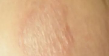 Сухое пятно на груди