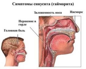 Постоянная заложенность носа, частые боли в горле