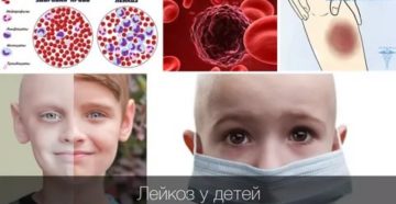 Похоже ли на лейкоз