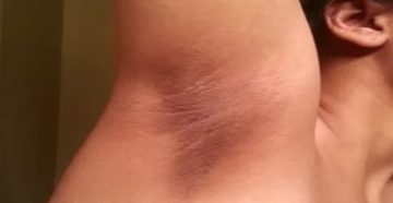 Неровная кожа на подмышках