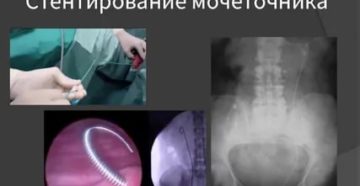 Стентирование мочеточника Стентирование мочеточника