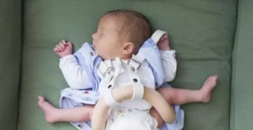 Дисплазия суставов у 3х месячного ребенка