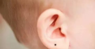 Пятно на мочке уха Пятно на мочке уха